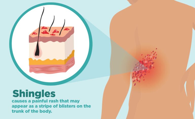 Shingles Pain: Causes, Symptoms, and Treatment